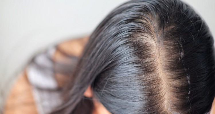 Telogen Effluvium Saç Dökülmesi Tedavisi Telogen Effluvium Saç Dökülmesi Tedavisi