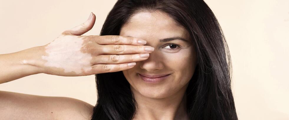 Vitiligo Tedavisi Vitiligo Tedavisi