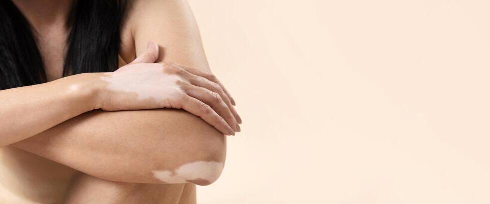 Vitiligo Tedavisi Vitiligo Tedavisi